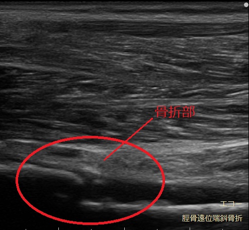 エコーでみる脛骨遠位端斜骨折の画像