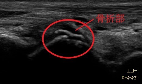 エコーでみる距骨骨折の画像