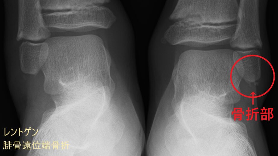 レントゲンでみる腓骨遠位端骨折の画像