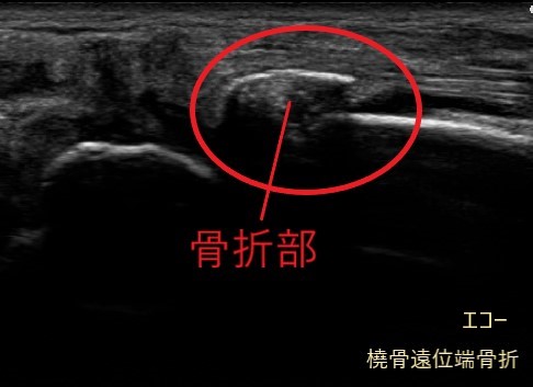 エコーでみる橈骨遠位端骨の画像