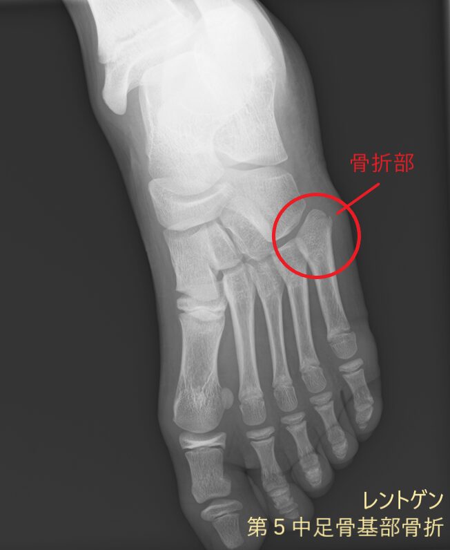 レントゲンでみる第５中足骨基部骨折の画像